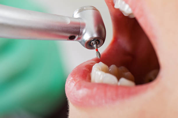 Best Emergency Wisdom Tooth Extraction in Lackland Af, TX